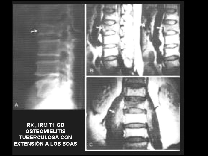 RX , IRM T 1 GD OSTEOMIELITIS TUBERCULOSA CON EXTENSIÓN A LOS SOAS 