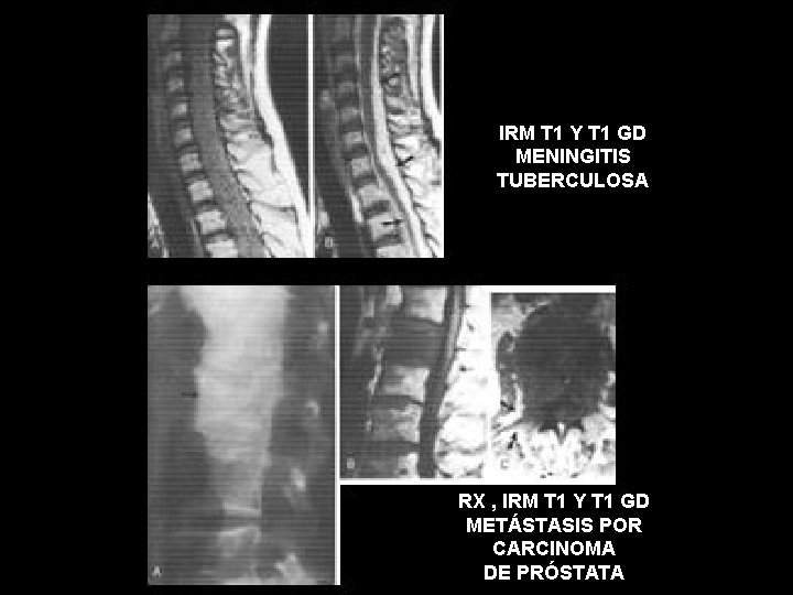 IRM T 1 Y T 1 GD MENINGITIS TUBERCULOSA RX , IRM T 1