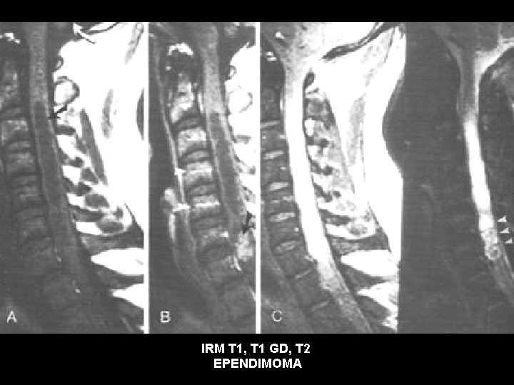 IRM T 1, T 1 GD, T 2 EPENDIMOMA 