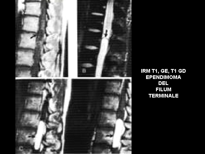 IRM T 1, GE, T 1 GD EPENDIMOMA DEL FILUM TERMINALE 