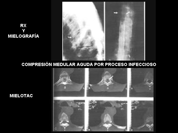 RX Y MIELOGRAFÍA COMPRESIÓN MEDULAR AGUDA POR PROCESO INFECCIOSO MIELOTAC 