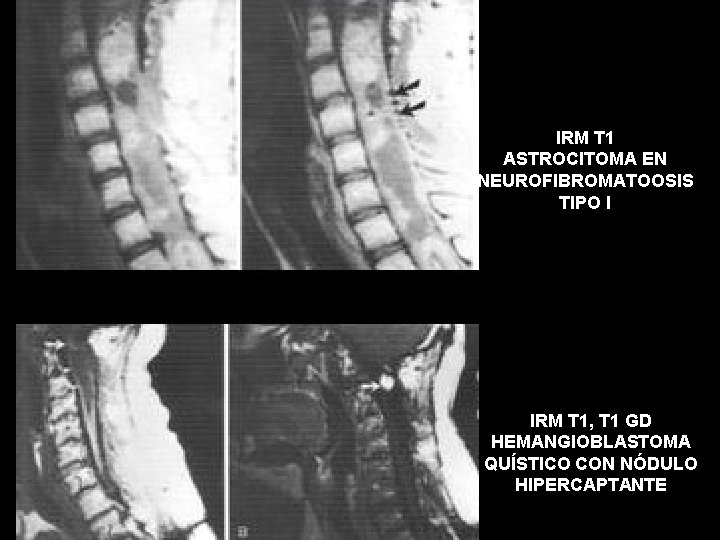 IRM T 1 ASTROCITOMA EN NEUROFIBROMATOOSIS TIPO I IRM T 1, T 1 GD