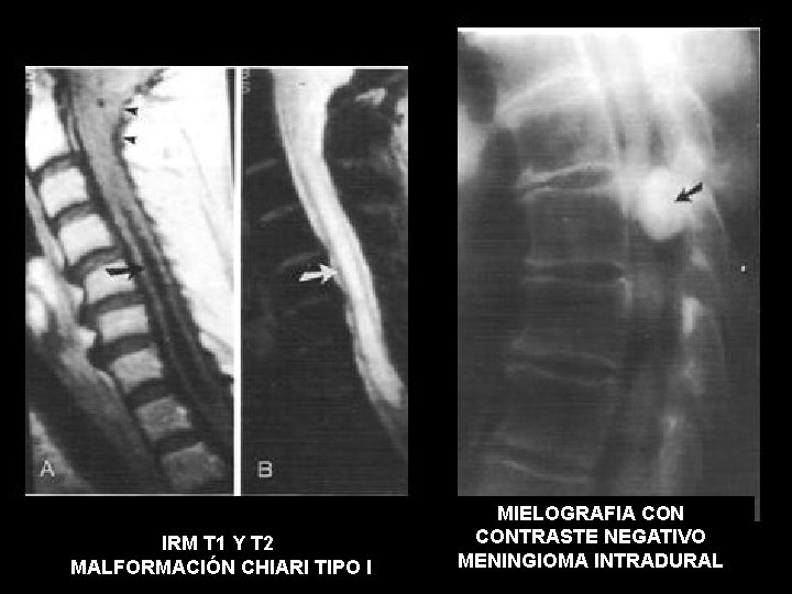 IRM T 1 Y T 2 MALFORMACIÓN CHIARI TIPO I MIELOGRAFIA CONTRASTE NEGATIVO MENINGIOMA