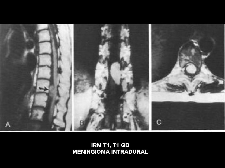 IRM T 1, T 1 GD MENINGIOMA INTRADURAL 
