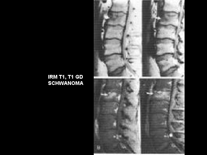 IRM T 1, T 1 GD SCHWANOMA 