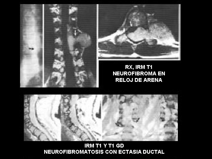 RX, IRM T 1 NEUROFIBROMA EN RELOJ DE ARENA IRM T 1 Y T