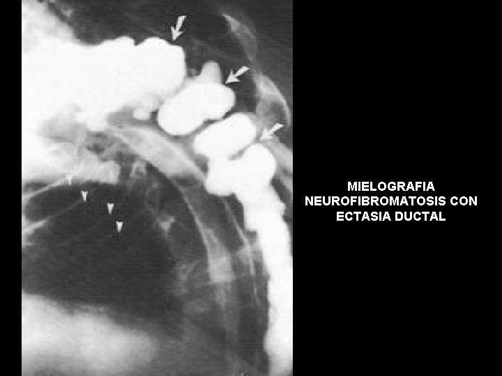 MIELOGRAFIA NEUROFIBROMATOSIS CON ECTASIA DUCTAL 