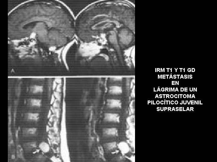 IRM T 1 Y T 1 GD METÁSTASIS EN LÁGRIMA DE UN ASTROCITOMA PILOCÍTICO