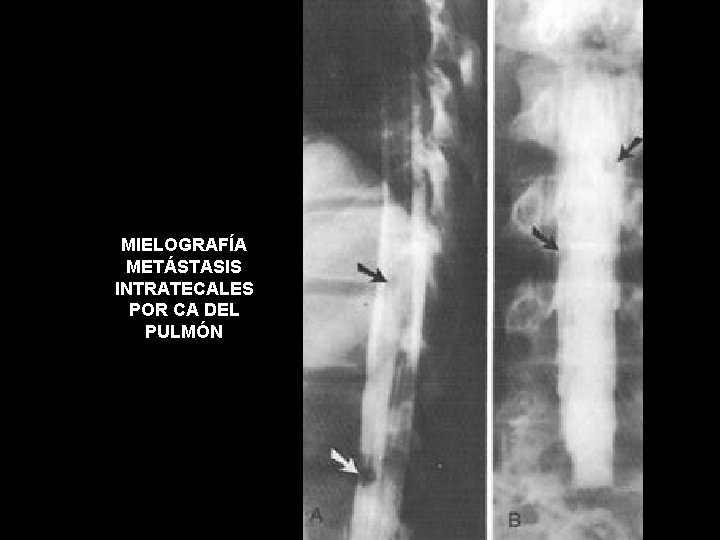 MIELOGRAFÍA METÁSTASIS INTRATECALES POR CA DEL PULMÓN 