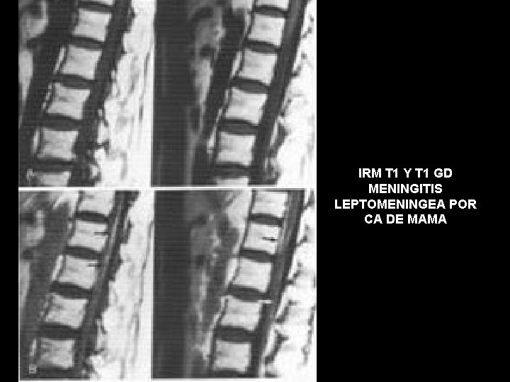 IRM T 1 Y T 1 GD MENINGITIS LEPTOMENINGEA POR CA DE MAMA 