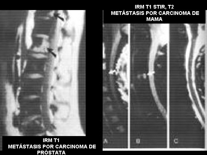 IRM T 1 STIR, T 2 METÁSTASIS POR CARCINOMA DE MAMA IRM T 1