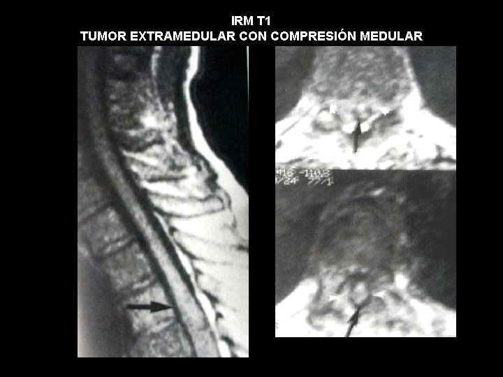 IRM T 1 TUMOR EXTRAMEDULAR CON COMPRESIÓN MEDULAR 