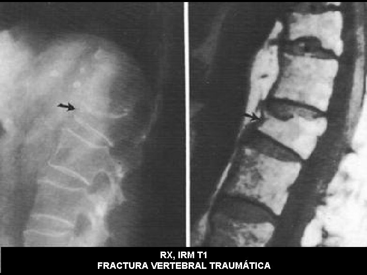 RX, IRM T 1 FRACTURA VERTEBRAL TRAUMÁTICA 