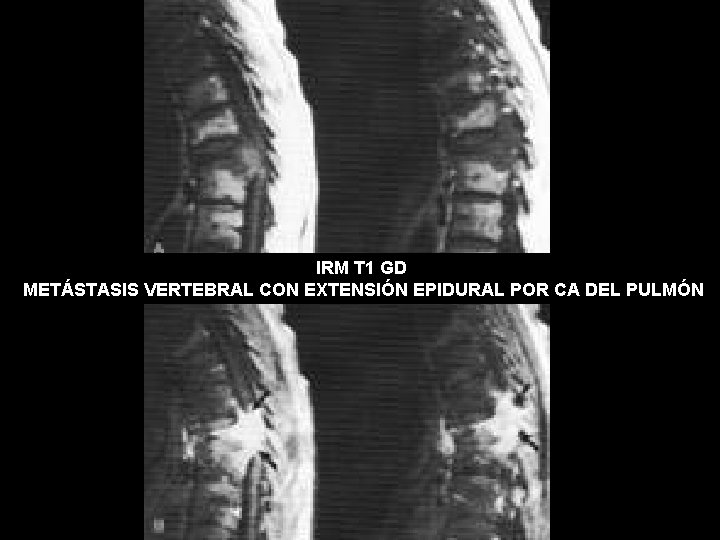 IRM T 1 GD METÁSTASIS VERTEBRAL CON EXTENSIÓN EPIDURAL POR CA DEL PULMÓN 