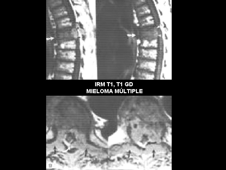 IRM T 1, T 1 GD MIELOMA MÚLTIPLE 