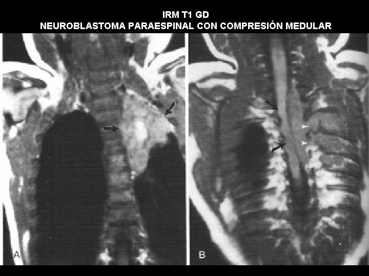 IRM T 1 GD NEUROBLASTOMA PARAESPINAL CON COMPRESIÓN MEDULAR 