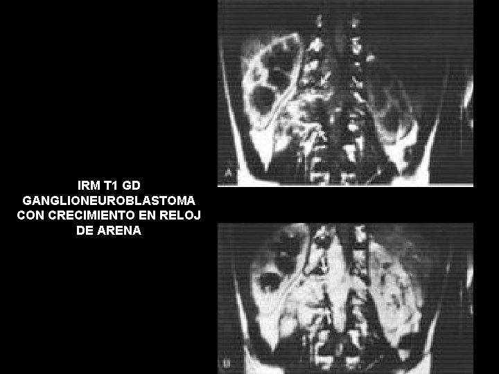 IRM T 1 GD GANGLIONEUROBLASTOMA CON CRECIMIENTO EN RELOJ DE ARENA 