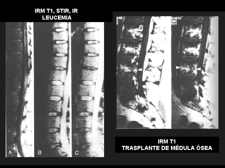 IRM T 1, STIR, IR LEUCEMIA IRM T 1 TRASPLANTE DE MÉDULA ÓSEA 
