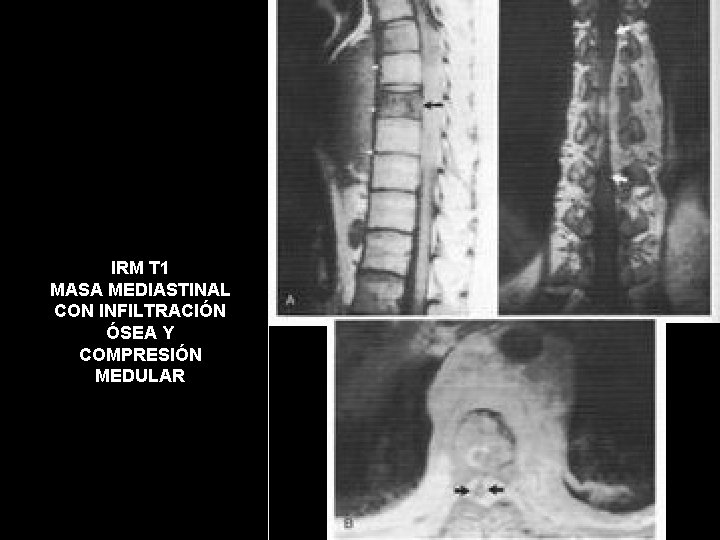 IRM T 1 MASA MEDIASTINAL CON INFILTRACIÓN ÓSEA Y COMPRESIÓN MEDULAR 