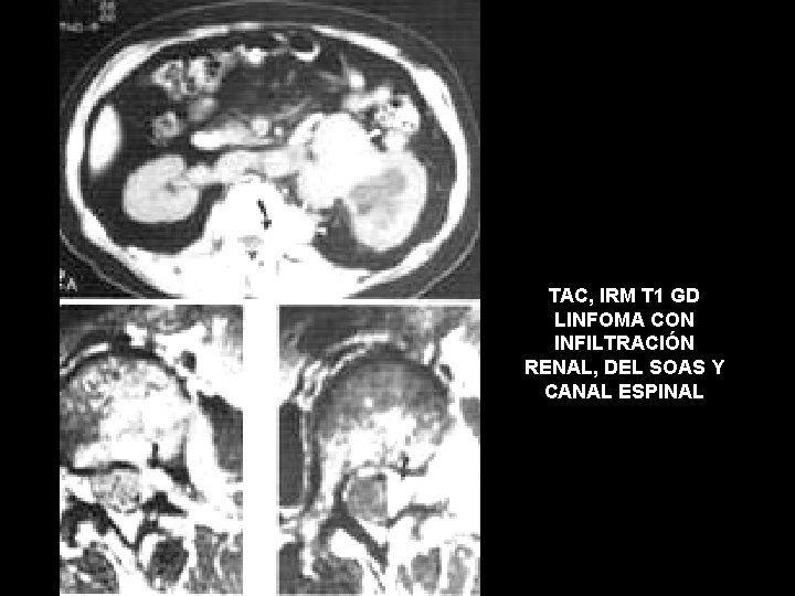 TAC, IRM T 1 GD LINFOMA CON INFILTRACIÓN RENAL, DEL SOAS Y CANAL ESPINAL