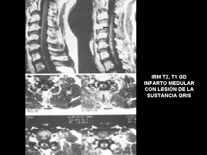 IRM T 2, T 1 GD INFARTO MEDULAR CON LESIÓN DE LA SUSTANCIA GRIS