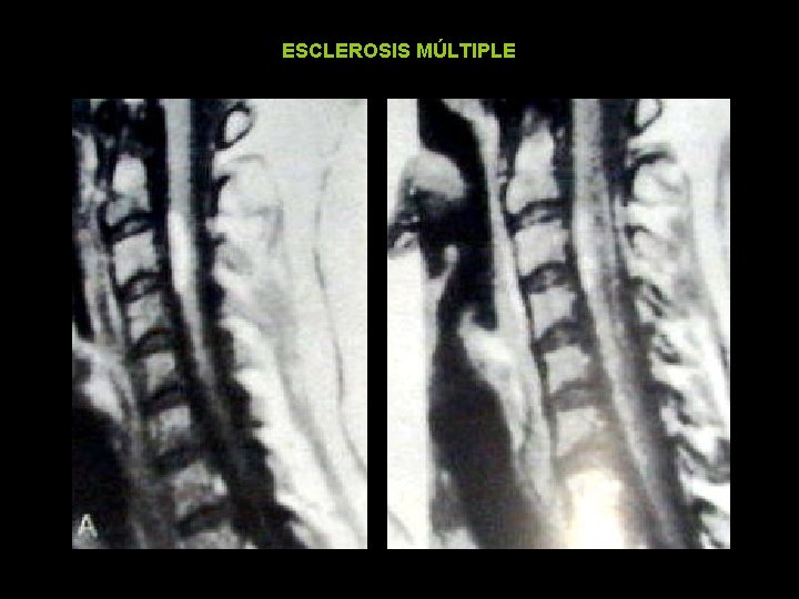 ESCLEROSIS MÚLTIPLE 