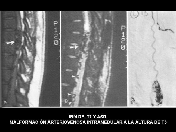 IRM DP, T 2 Y ASD MALFORMACIÓN ARTERIOVENOSA INTRAMEDULAR A LA ALTURA DE T