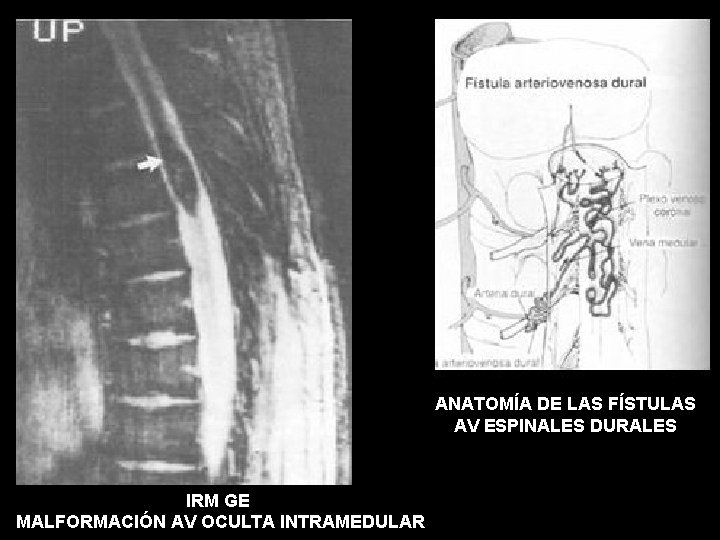 ANATOMÍA DE LAS FÍSTULAS AV ESPINALES DURALES IRM GE MALFORMACIÓN AV OCULTA INTRAMEDULAR 