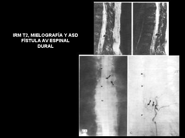IRM T 2, MIELOGRAFÍA Y ASD FÍSTULA AV ESPINAL DURAL 