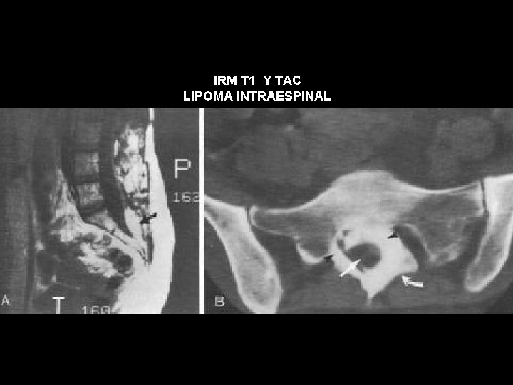 IRM T 1 Y TAC LIPOMA INTRAESPINAL 