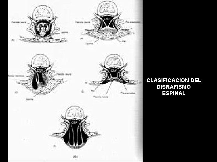 CLASIFICACIÓN DEL DISRAFISMO ESPINAL 