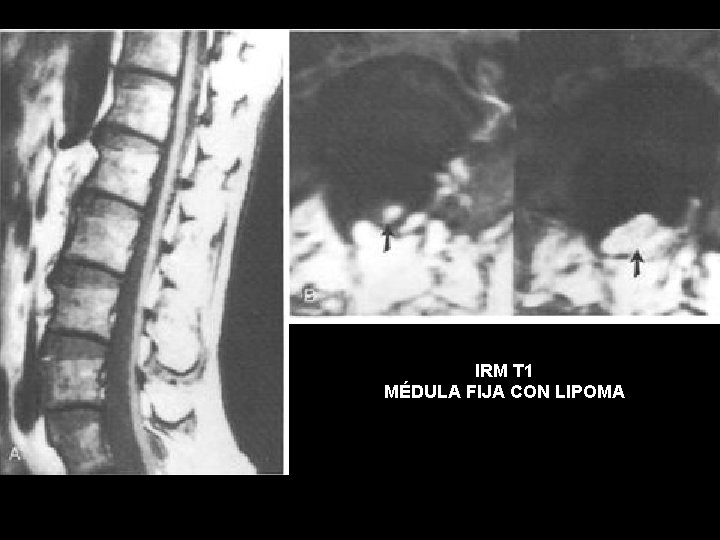 IRM T 1 MÉDULA FIJA CON LIPOMA 