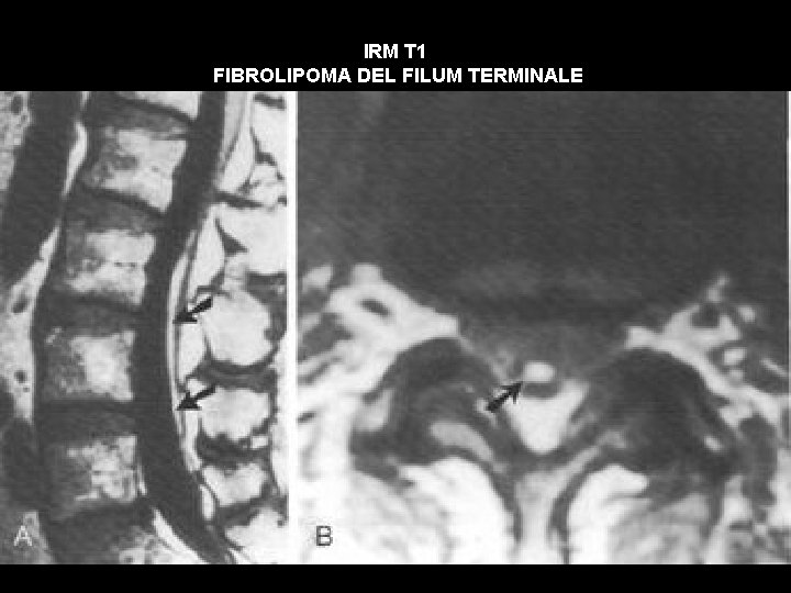 IRM T 1 FIBROLIPOMA DEL FILUM TERMINALE 