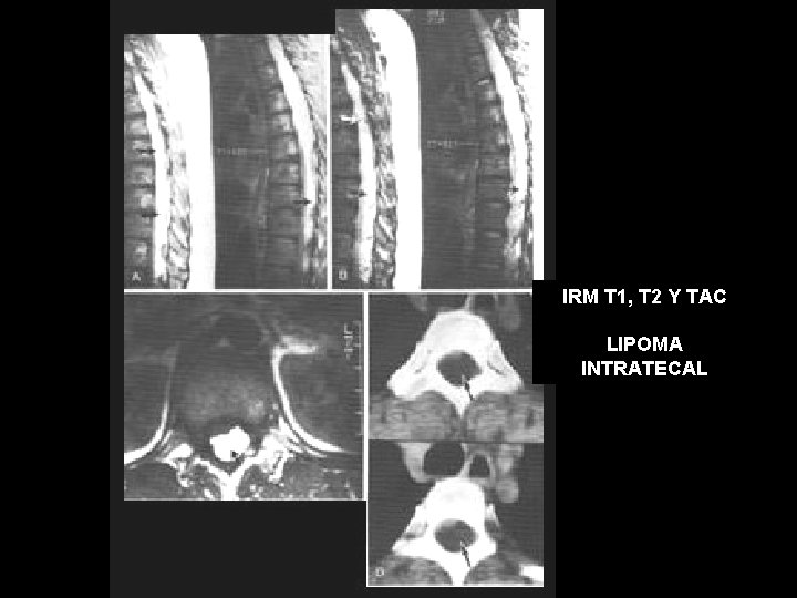 IRM T 1, T 2 Y TAC LIPOMA INTRATECAL 