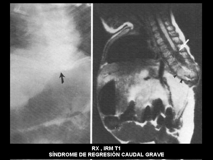 RX , IRM T 1 SÍNDROME DE REGRESIÓN CAUDAL GRAVE 