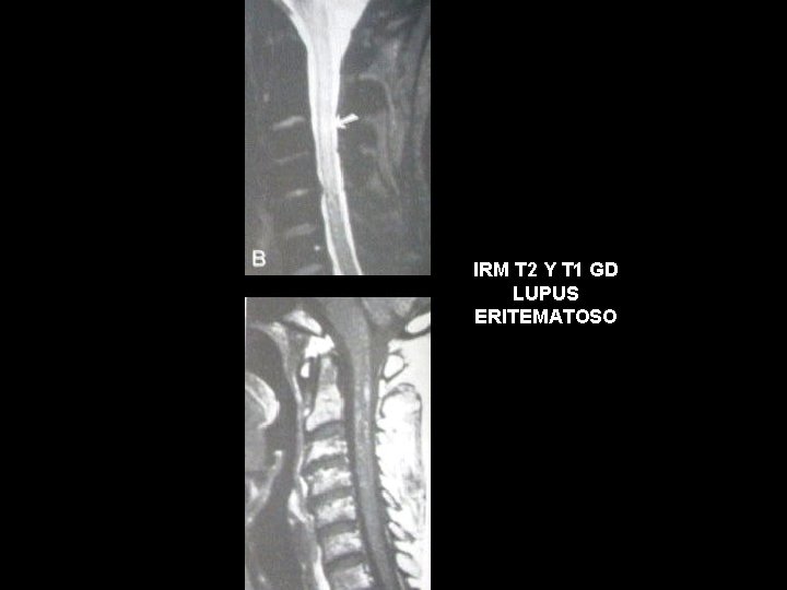 IRM T 2 Y T 1 GD LUPUS ERITEMATOSO 