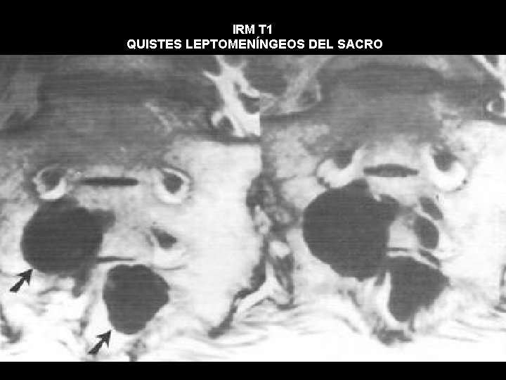 IRM T 1 QUISTES LEPTOMENÍNGEOS DEL SACRO 
