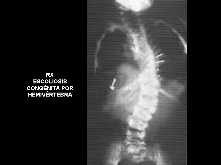 RX ESCOLIOSIS CONGÉNITA POR HEMIVÉRTEBRA 