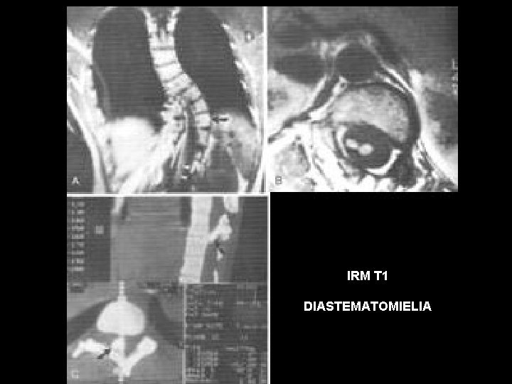 IRM T 1 DIASTEMATOMIELIA 