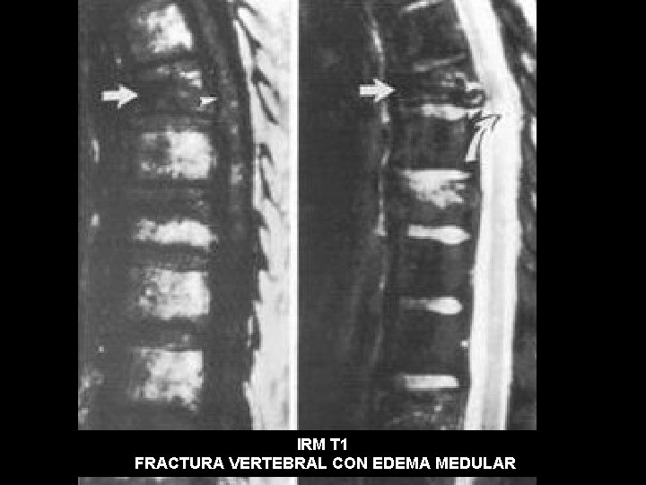 IRM T 1 FRACTURA VERTEBRAL CON EDEMA MEDULAR 