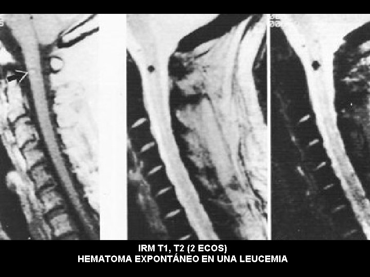 IRM T 1, T 2 (2 ECOS) HEMATOMA EXPONTÁNEO EN UNA LEUCEMIA 