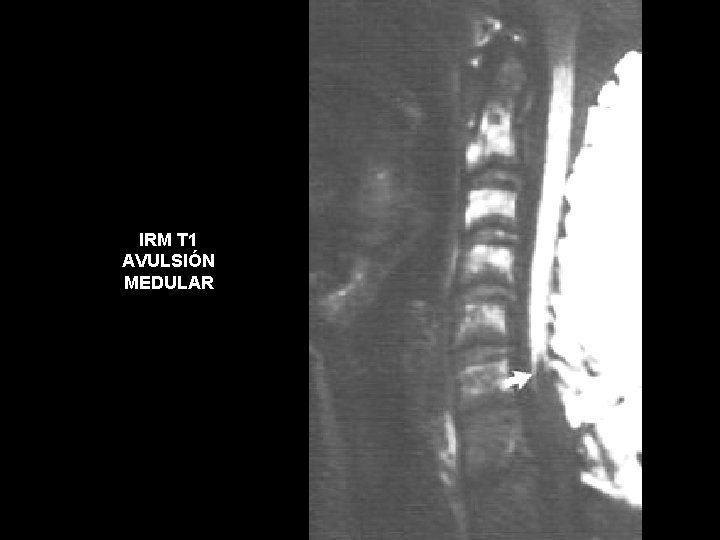 IRM T 1 AVULSIÓN MEDULAR 