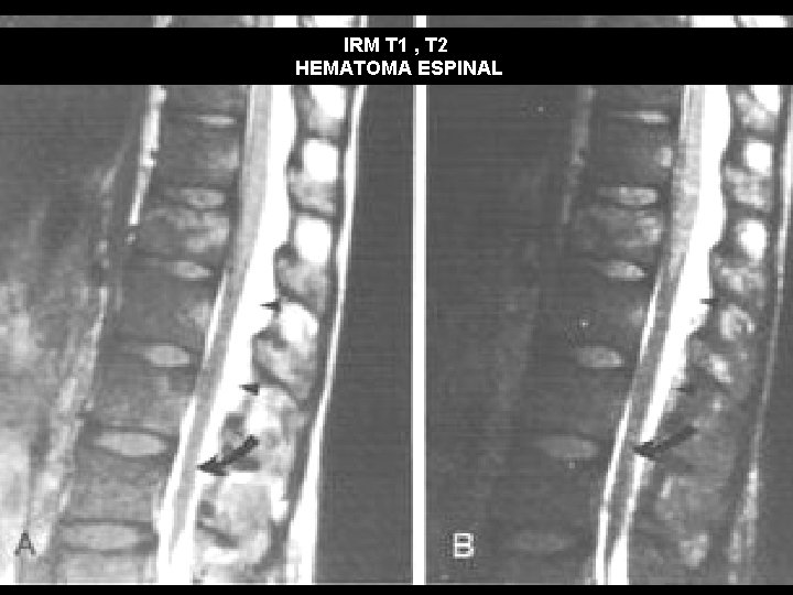 IRM T 1 , T 2 HEMATOMA ESPINAL 