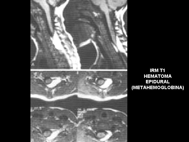 IRM T 1 HEMATOMA EPIDURAL (METAHEMOGLOBINA) 
