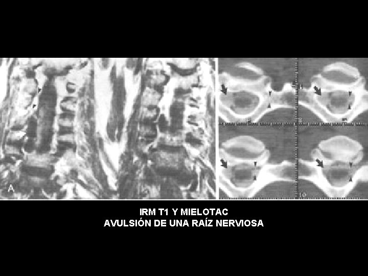IRM T 1 Y MIELOTAC AVULSIÓN DE UNA RAÍZ NERVIOSA 