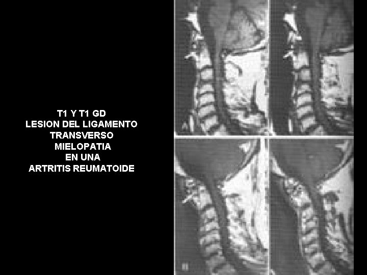 T 1 Y T 1 GD LESION DEL LIGAMENTO TRANSVERSO MIELOPATIA EN UNA ARTRITIS