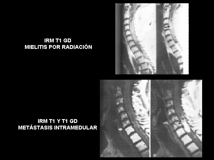 IRM T 1 GD MIELITIS POR RADIACIÓN IRM T 1 Y T 1 GD