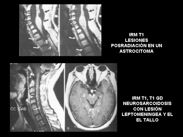 IRM T 1 LESIONES POSRADIACIÓN EN UN ASTROCITOMA IRM T 1, T 1 GD