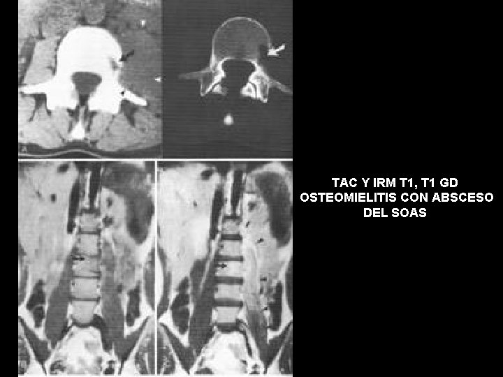 TAC Y IRM T 1, T 1 GD OSTEOMIELITIS CON ABSCESO DEL SOAS 