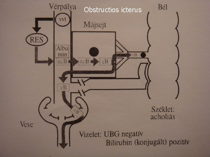 Obstructios icterus 